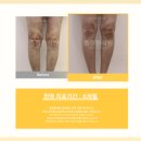 본오마디의원·한의원 | 피부, 팔다리, 몸에 붉은 반점이 생기고 가려움증까지? 2가지 확인하세요.