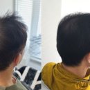 명곡동207 | 50대 중반 남성 정수리탈모 두피 커버 SMP 후기(스타스칼프)탈모 고민 끝