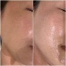 상남동254 | 창원 상남동 피부관리 여드름 약초필링 9회차 르네아 바이더랩