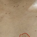연산한의원 | [내돈쓰고온후기] 연산역한의원에서 얼굴과 상반신 편평사마귀 제거 1탄
