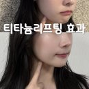 티타늄리프팅추천, 효과 유지기간 통증 가격에 대한 솔직후기