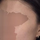 행복한의원 | 가산 한의원 추천 여드름 흉터 치료 새살침 효과 내돈내산 후기