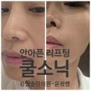강남바른스케치의원 | 윤정쌤 찾아 솔린의원^^-안 아픈 리프팅 쿨소닉 후기