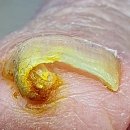 홀드핀칭 이미지