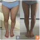 허벅지지흡 후기 부평지방흡입 3개월차 Q&amp;A, 승마살, 흉터, 부작용