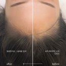 지성헤어라인 | 부천) 헤어라인문신/헤어라인반영구 솔직후기,효과