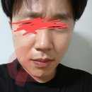 무서운 매복 사랑니 발치후기