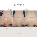 WITCH피부샵 | 구월동에스테틱 화이트위치에서 등각질케어 알라딘필링 받고왔어요