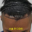 중앙헤어라인 이미지
