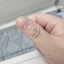 에스엘서울병원 | 손톱 밑 통증 사구체종양 병원 양주에스엘