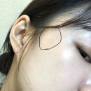 미파문피부과의원 | 미파문피부과 점뺀 후기