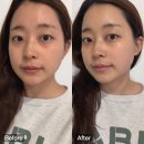 마곡에스테틱 피부에봄 얼굴축소 브이라인 윤곽관리 후기
