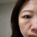 포나 에스테틱(FONA) | PDRN 연어앰플 후기 팔자미간주름에 효과적인 포나777
