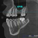 양쪽 어금니 고난도 상악동 뼈이식 임플란트 식립 후기 - 수원 장안구 치과 추천