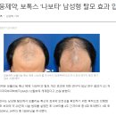 대웅제약, 보톡스 '나보타' 남성형 탈모 효과 입증 이미지