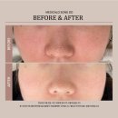 연수메티컬 | 송도 모공 메디컬오 리액터로 여름철 피지와 민감성 피부 한 번에 해결