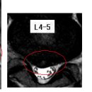 임영택 님의 요추디스크 L4-5, L5-S1의 MRI 사진 판독입니다. [4급 판정] 이미지
