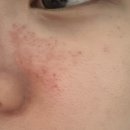 (주)와이비랩 서울지사 | 서울 은평 모공각화증 피부 콜드플라즈마의 효과 보기! 이지 뷰티랩