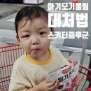 여울약국 | 아기 눈 위 모기 물림 붓기 3일~7일 후기 스키터 증후군 대처법