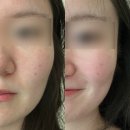 바른차오토샵 | [웨딩관리] 원주 무실동 피부관리 바른미 에스테틱, 프리미엄 발몽바이탈리티 케어 후기