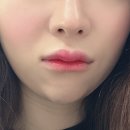 우외과의원 | 서울 강남｜오호성형외과｜얼테기 극복:: 강남역 턱필러, 입술필러, 사각턱보톡스, 자갈턱 보톡스 후기