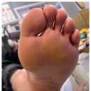 강서발각질 대만족 후기 베티네일 내성발톱 무좀 발각질 문제성발