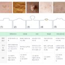 비립종과 쥐젖 제거 후기 – 실제 경험과 예방법까지!