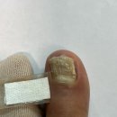 더쉼가정의학과의원 | 운동 후 발톱눌림 치료 및 발가락골무 보호대 사용 후기