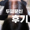 압구정 | 압구정 두피문신 후기 정수리 걱정 없이