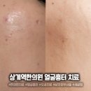 상계역한의원 얼굴흉터제거 패인흉터피부과 6회차 리뷰