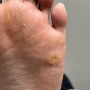 푸스케어 원주점 | 원주무좀 고민으로 방문한 푸스케어 원주점 티눈 관리 후기👣