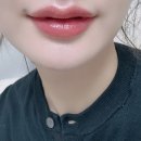 말턱고개 | 턱필러 입술필러후기 만족스러운 정리