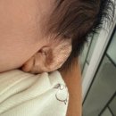 동안미의원 | 신생아 귀접힘 귀교정 꼭 해야 할까 미사린청소년의원 비급여 비용 솔직후기