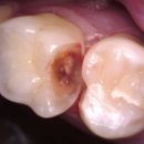 경희다강한의원 | 인레이 교합, 작은 오차가 큰 불편감으로 이어질 수도..