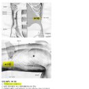 ﻿원장 왼쪽 옆구리-통증-장문혈에서 고름이---임상 이미지
