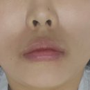 더고운성형외과의원 | 대구 중구 반월당 내돈내산 입꼬리 가로 확장 입술 필러 리프트성형외과의원