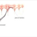 치석제거 방법 이미지