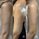 멍스토리 | 일산 팔뚝 람스 일주일 솔직 후기 *생각보다 안 아픔, 멍 거의 없음, 일상 생활 지장 없음