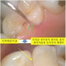 이바른치과기공소 네이버블로그