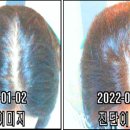 이안두피탈모 이미지