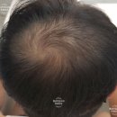 내 남자의 머리카락을 지켜다오#미녹시딜#로게인폼#탈모약#내돈내산#2달사용후기