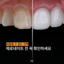 티유치과의원 | 제로네이트, '이것' 때문에 한다면 신중해야 합니다 장단점 꼭 알고 결정하세요