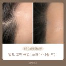 출산 후 M자 탈모 고민, 소레아 두피숱채움 솔직 후기｜양주 수소뷰티에스테틱