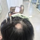 대구 정수리 원형탈모 5cm, 가발 없이 해결한 증모술 후기｜젤리아헤어 리아원장