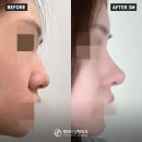 JT빌딩 | 코성형전후 셀카-콧대 굴곡이 신경 쓰였다면? 매부리코수술 후기로 비교해보세요!