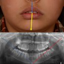 궁금한 키, 궁금한 사춘기 | 어린이 무턱과 비대칭, 액티베이터 및 헤드기어 이용한 성장기 소아교정 후기. 송파 교정치과