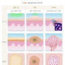 3. 사마귀 셀프제거 앤드와츠 후기(반려 사마귀와 이별하기 💀)