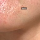 제로이드 인텐시브 크림 엠디 md 9통 내돈내산 후기(+성분, 여드름)