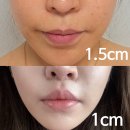 씨유 신기부은점 | 강남역성형외과 인중축소술 4mm 줄인 내돈내산 후기 <흉터 변화 과정 기록>