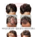바이오 테라피 100 티스토리